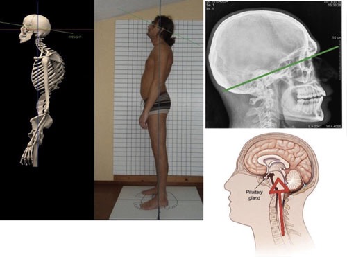 Collage: skeleton, man in profile, skull radiograph and brain diagram.