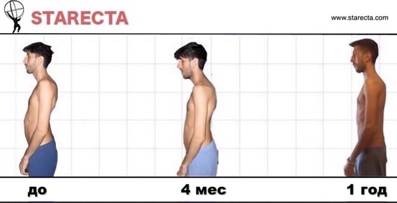 Как выпрямить позвоночник: метод Starecta