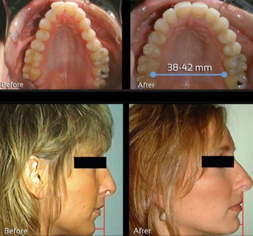 Collage: two intraoral photographs of upper teeth and two female profiles with black bars over the eyes; a blue line and the label 38-42 mm.