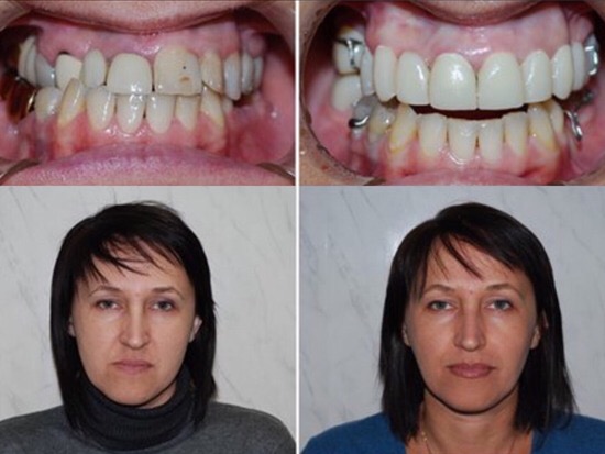 Collage: two photographs of teeth above and two frontal portraits of a woman below.