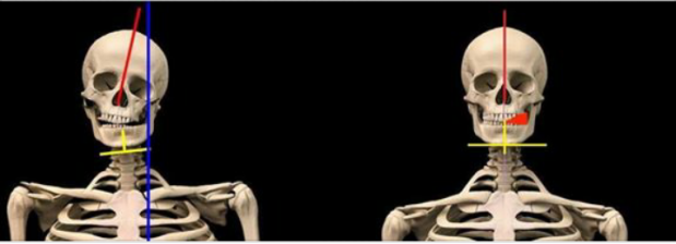 Two front views of a skeleton with coloured lines and a red arrow on a black background.
