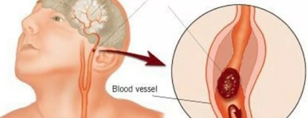 Head and neck vessels beside an enlarged blood vessel detail.