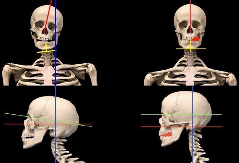 Illustration de la posture pour l’article d’archive sur la scoliose et l’ostéochondrose