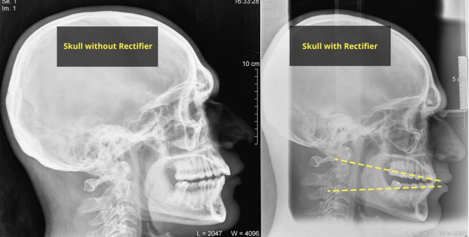 Two lateral skull radiographs with original labels and yellow lines.