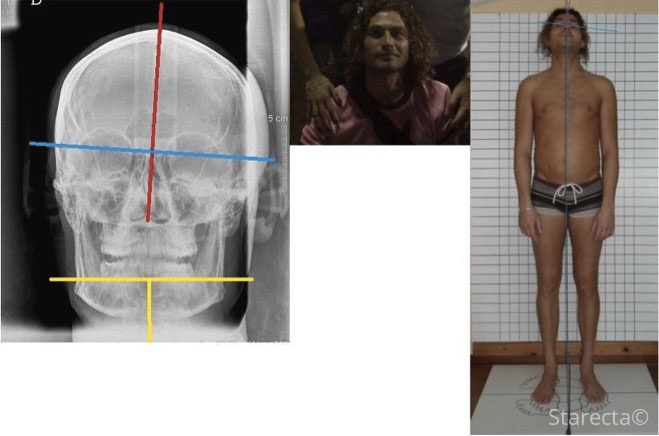 Collage: frontal skull radiograph, portrait and a man against a grid.