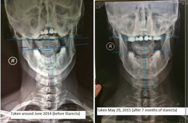 Two frontal skull radiographs with blue reference lines and time captions.