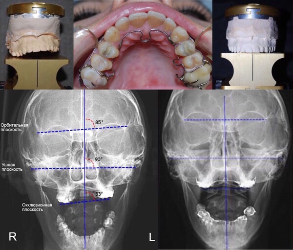Collage: dental models, an appliance in the mouth and two skull radiographs with measurement lines.