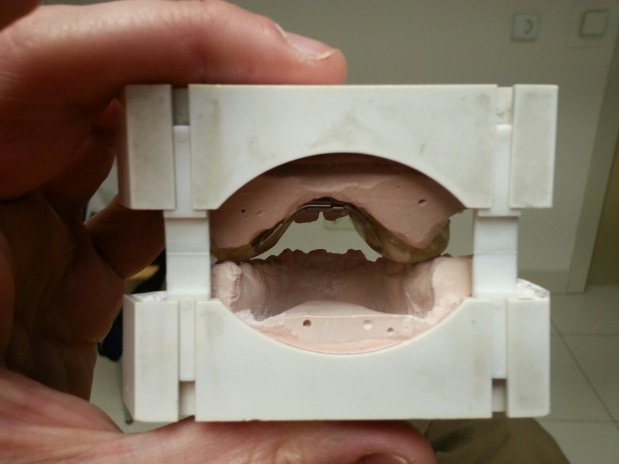 Dental models in a white holder held by a hand.