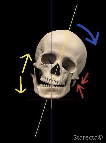 Skull model with coloured arrows and guide lines.