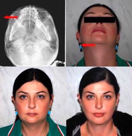 Collage: a skull radiograph, a face with the chin raised and a black bar over the eyes, two frontal portraits and red arrows.