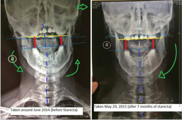 Two frontal skull radiographs with red, green, blue and yellow reference marks and time captions.