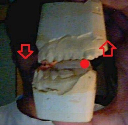 Photograph of dental models with red arrows and a dot.