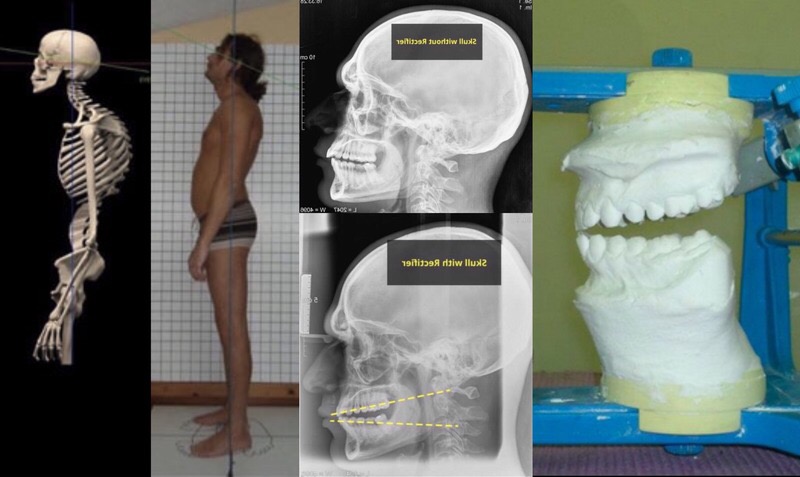 Preuves scientifiques de l’effet de l’occlusion sur la posture