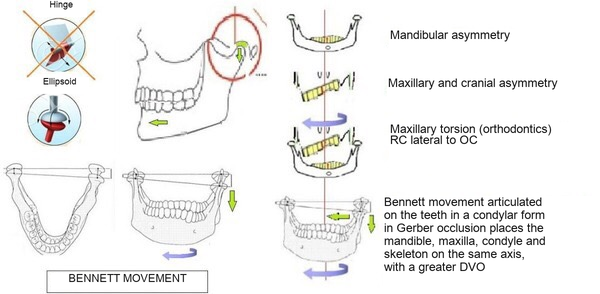 Several jaw diagrams with arrows and original captions about Bennett movement.
